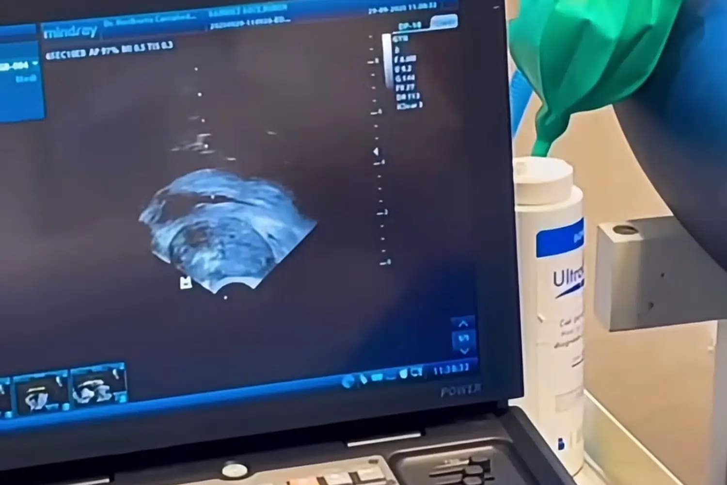 Biopsia transrectal de próstata guiada por ultrasonido